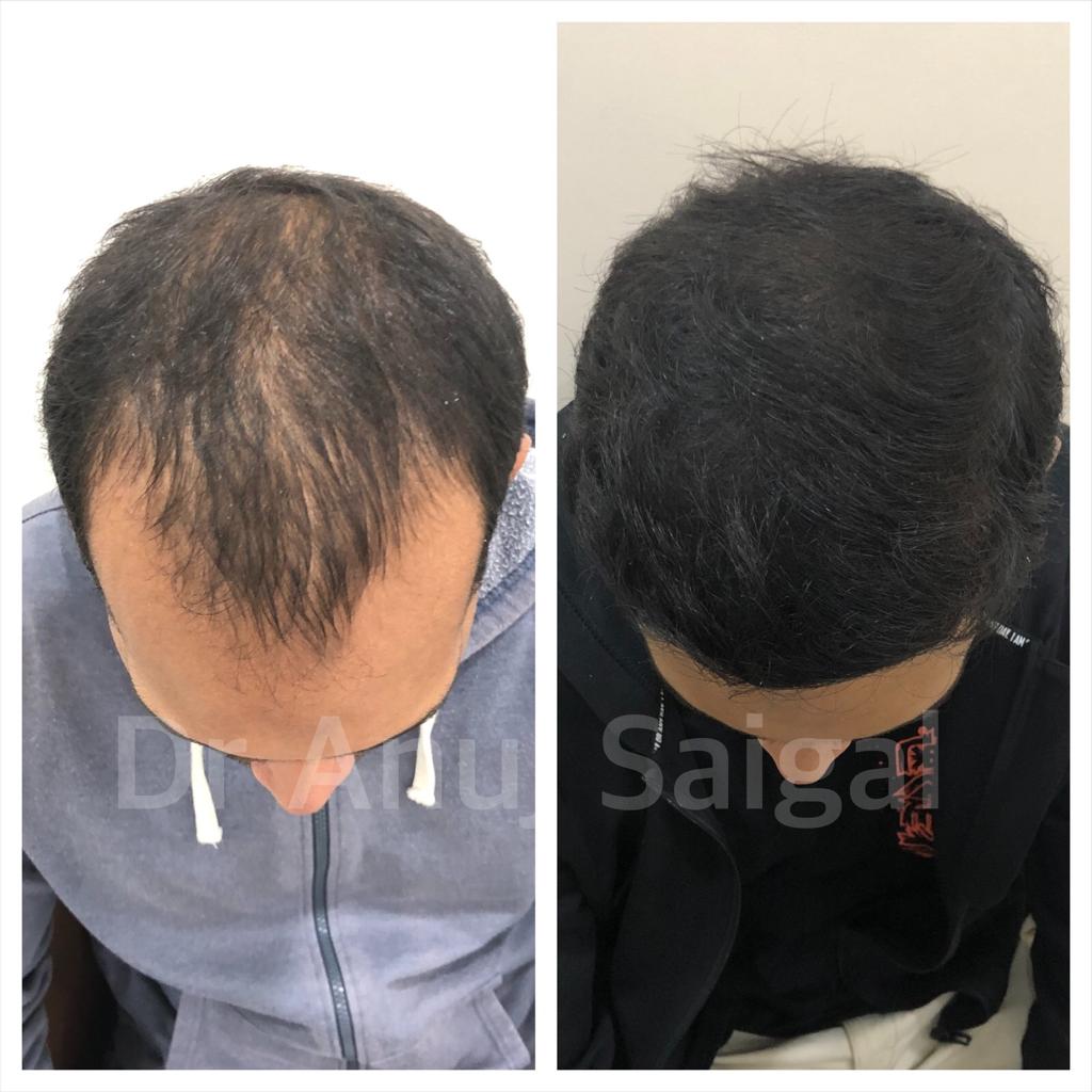 Best hair transplant doctor in delhi